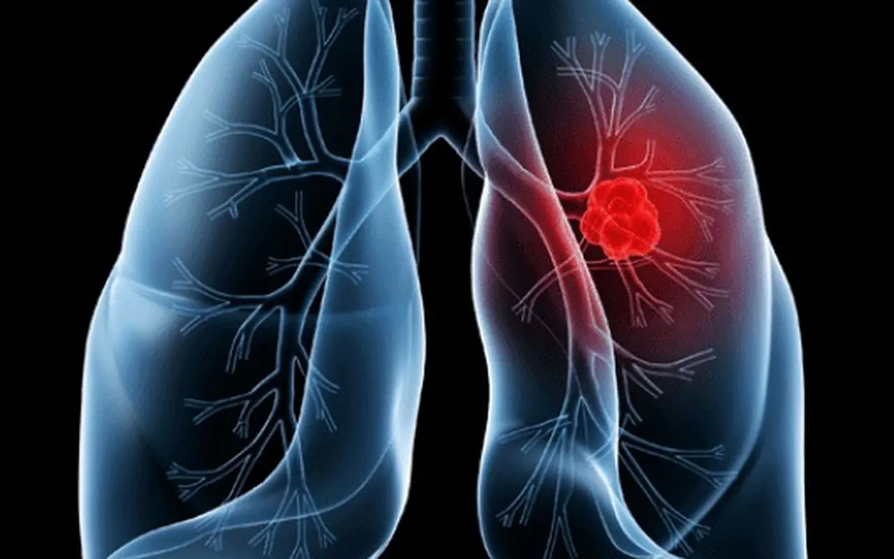 Saiba o que é adenocarcinoma pulmonar, câncer que atinge o papa