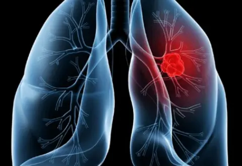 Saiba o que é adenocarcinoma pulmonar, câncer que atinge o papa